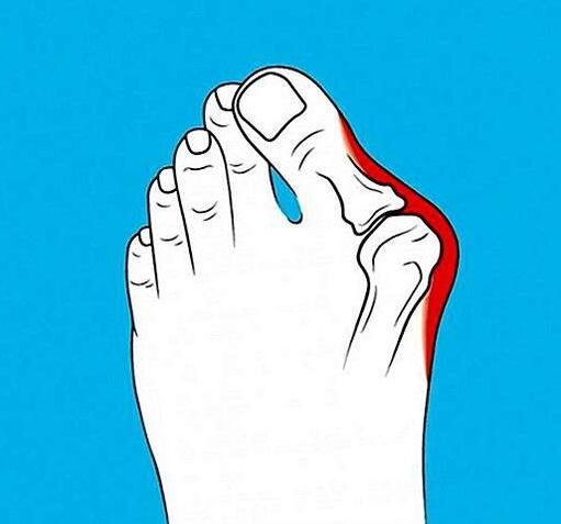 Arthropathy of the toe joint