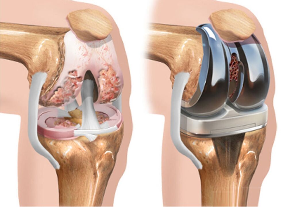 Before and after knee arthropathy
