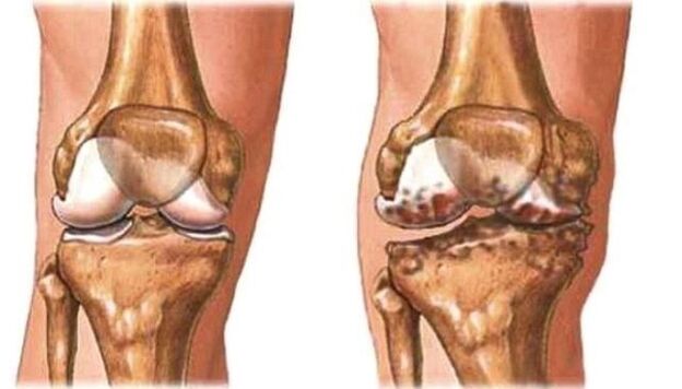 Healthy knee joints and knee joints