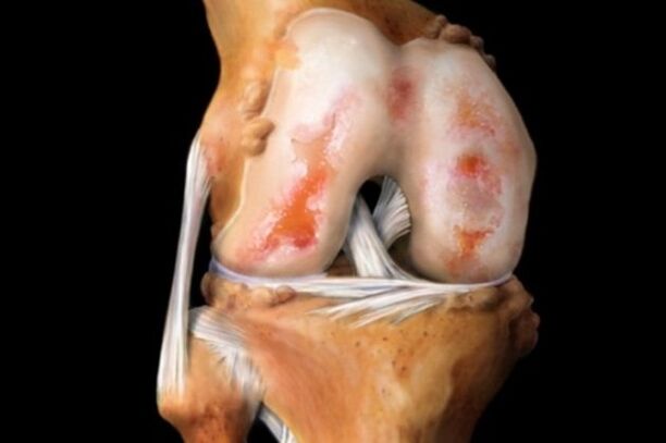 Knee cartilage injury