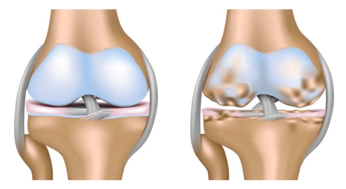 Damage to the knee from healthy cartilage and joint disease
