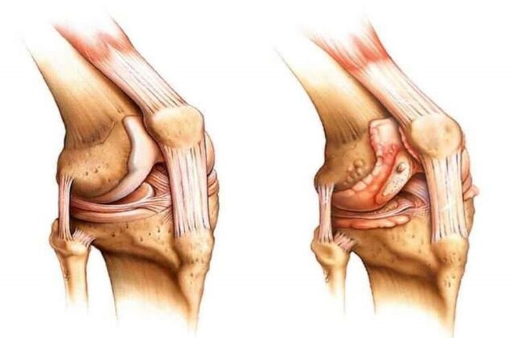 Healthy Knee and Knee Arthropathy