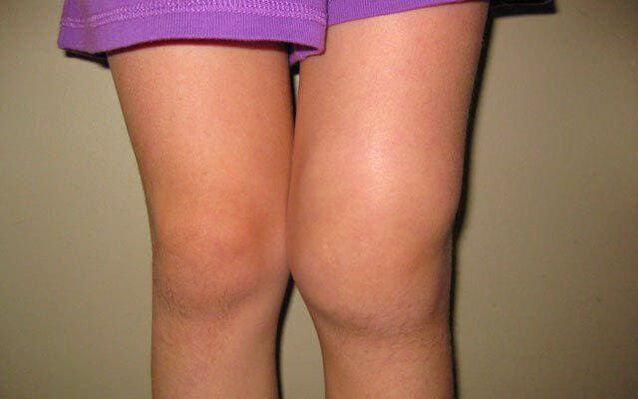 Knee swelling due to osteoarthritis