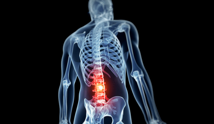 Lumbar spine injuries in osteochondrosis