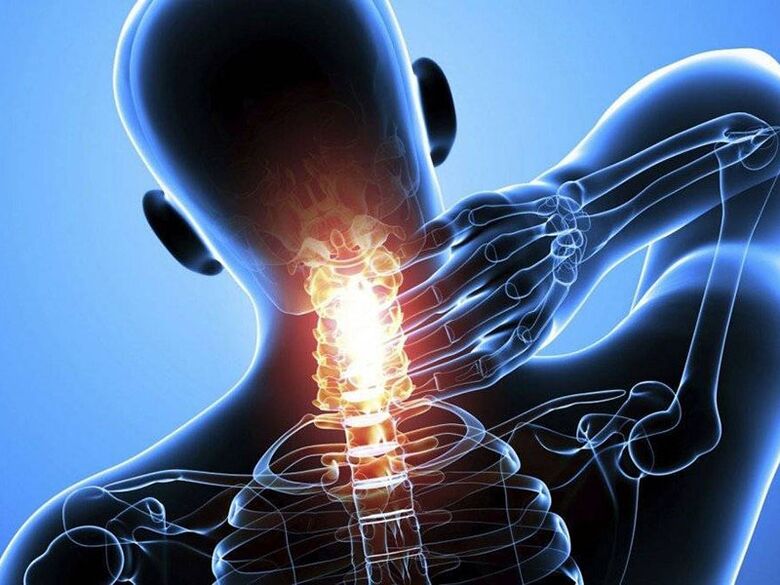 Cervical osteochondrosis with neck pain