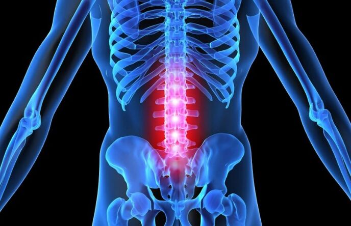 Osteochondral disease in the waist