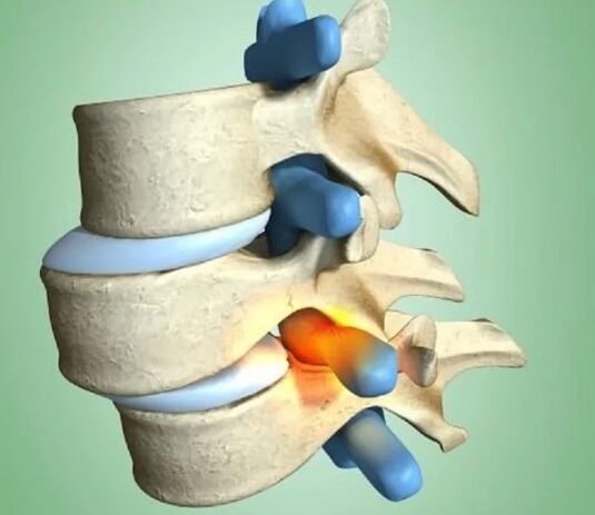 The location of unstable vertebrae