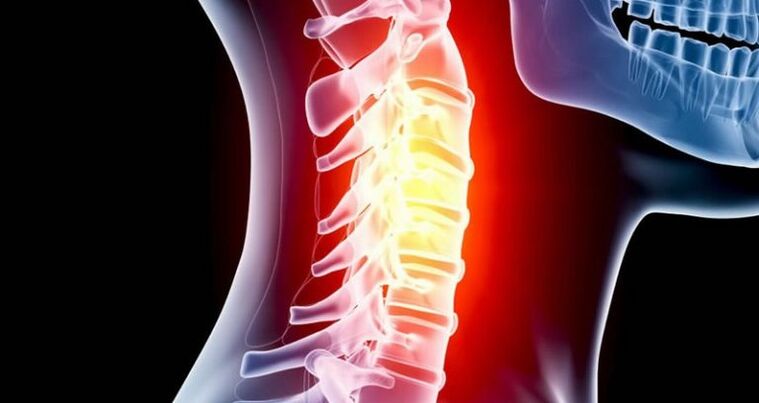 Neck inflammation
