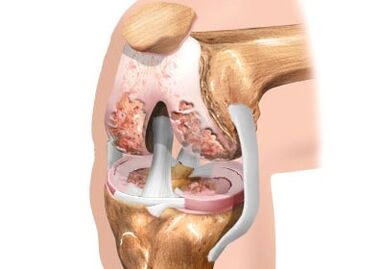 Knee joint articulation