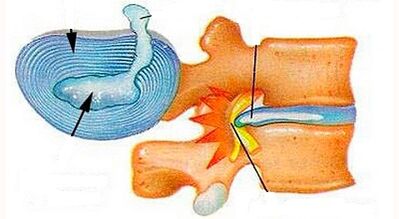Characteristics of development of cervical osteochondrosis