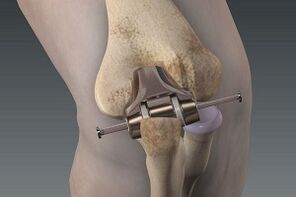 knee replacement surgery