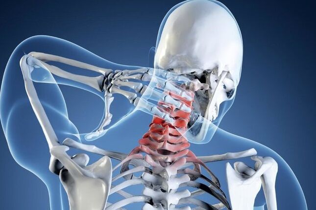 cervical osteochondrosis